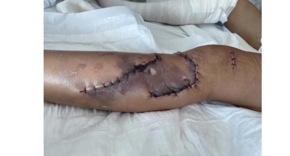 The 37-year-old's injured leg with stitches.