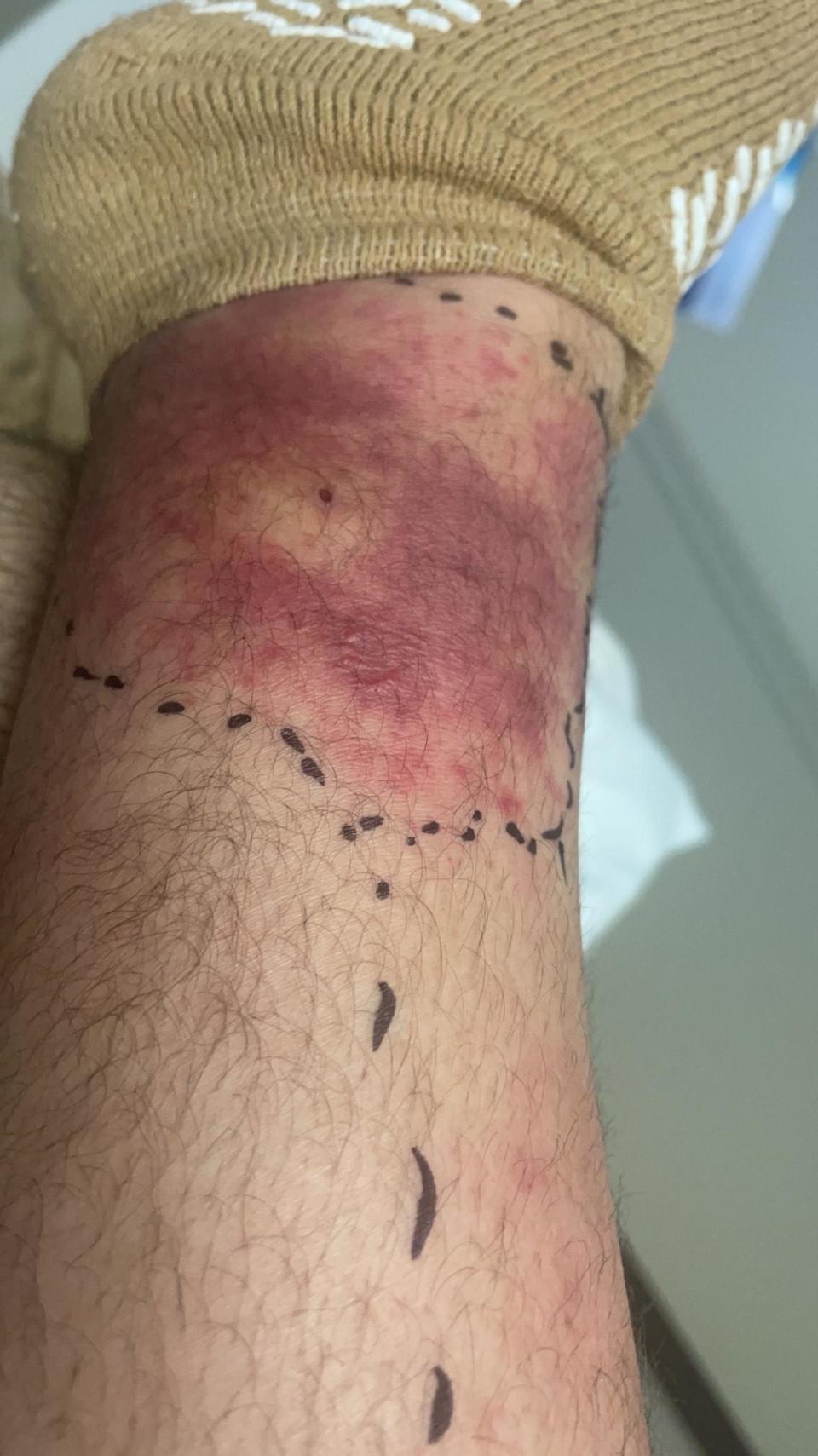 Gabe Lustman said doctors told him a brown recluse spider caused the bite that sparked swelling and an infection on his leg.  / Credit: Courtesy of Gabe Lustman