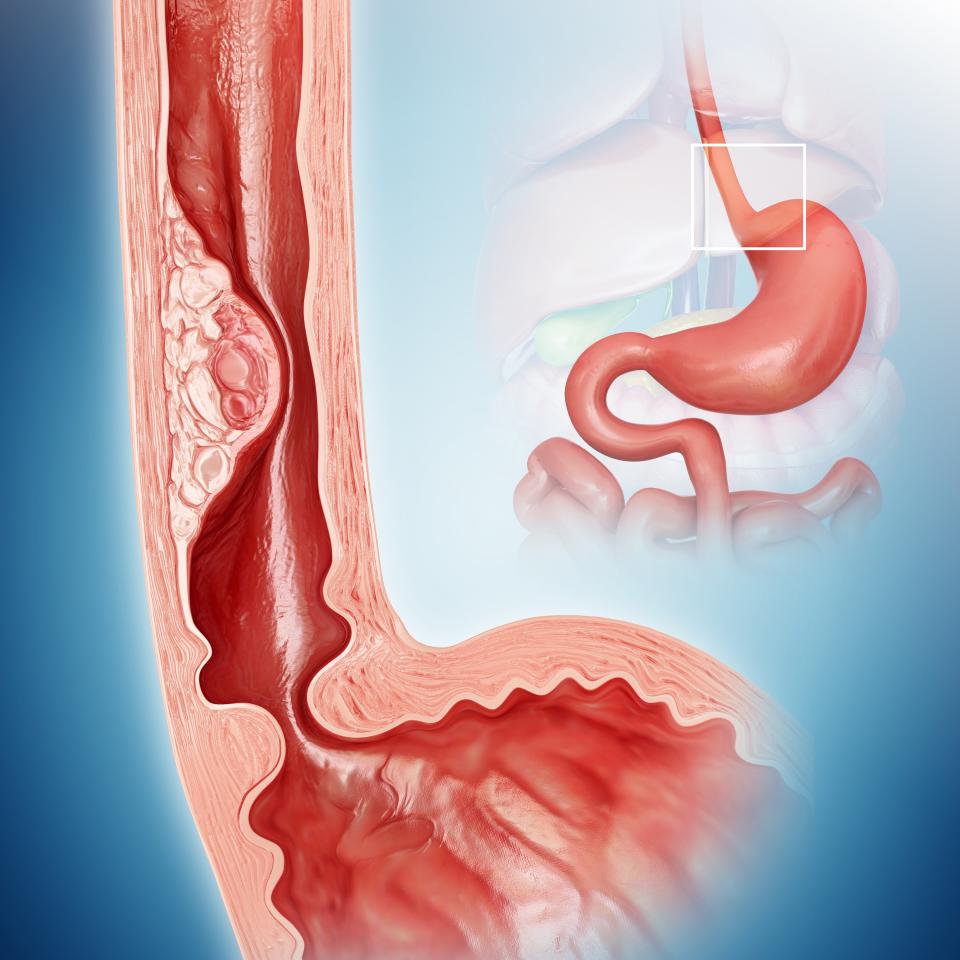 Esophageal cancer