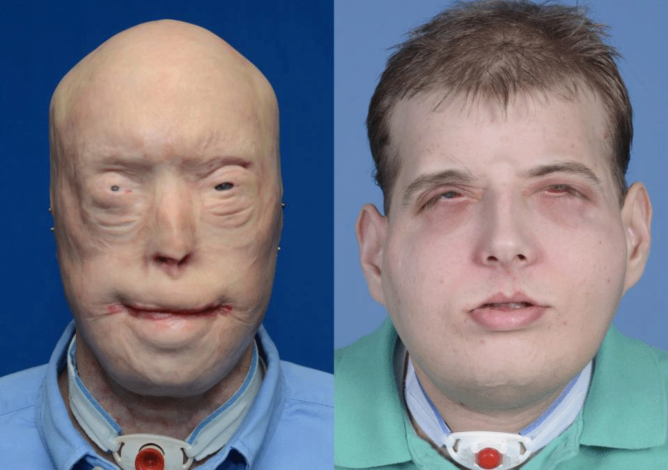 Patrick Hardison before and after his facial transplant surgery in New York. Photo: NYU Langone Medical Centre