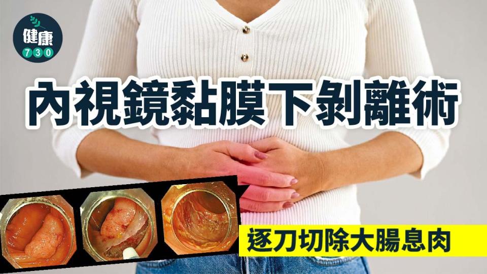 內視鏡黏膜下剝離術 切除大息肉