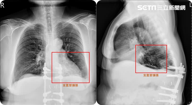 老婦喉嚨卡卡！左肺下方的支氣管變得粗大，裡面全被痰塞滿，確診是支氣管擴張症惹禍。（圖／翻攝畫面）