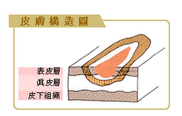 （資料來源／中華民國兒童燙傷基金會）