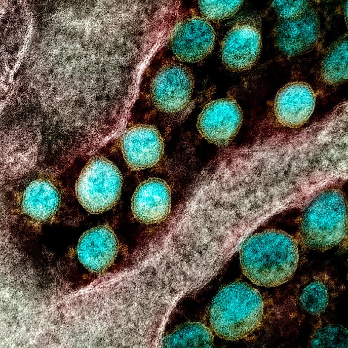 A transmission electron micrograph shows SARS-CoV-2 virus particles isolated from a patient. Recently, several research teams have honed in on potential hallmarks of long COVID, formally known as post-COVID-19 condition. (U.S. National Institutes of Health - image credit)