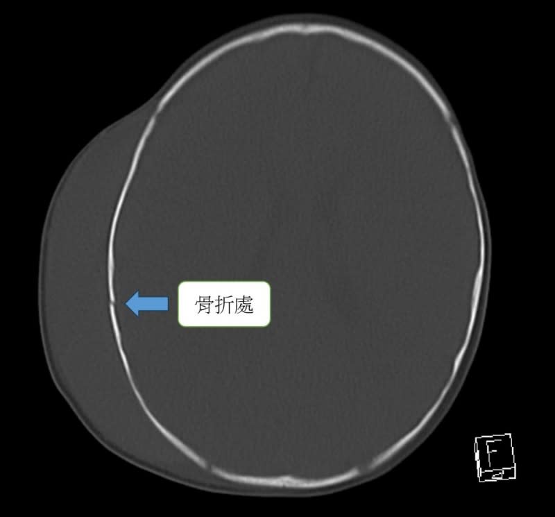 <cite>若要造成寶寶頭骨骨折，其實是要相當大的外力。（圖／翻攝自FB／布農Doc 田知學）</cite>