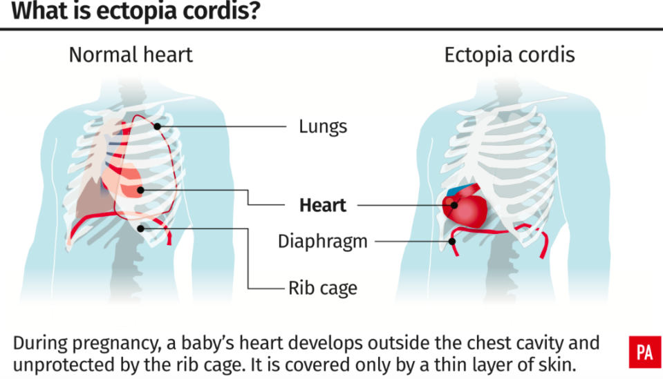 <em>Ectopia cordis is an extremely rare condition (PA)</em>