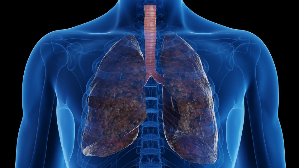 Smoker's lungs, illustration