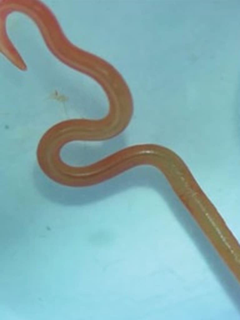 8cm worm pulled from canberra woman's brain