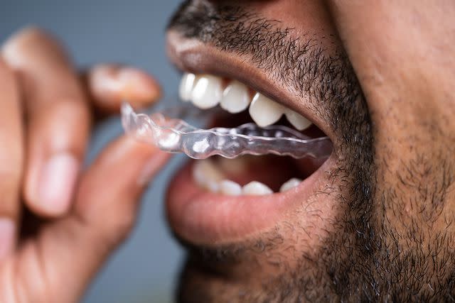 <p>Getty</p> Close-up of a man's hand putting a transparent aligner in his teeth