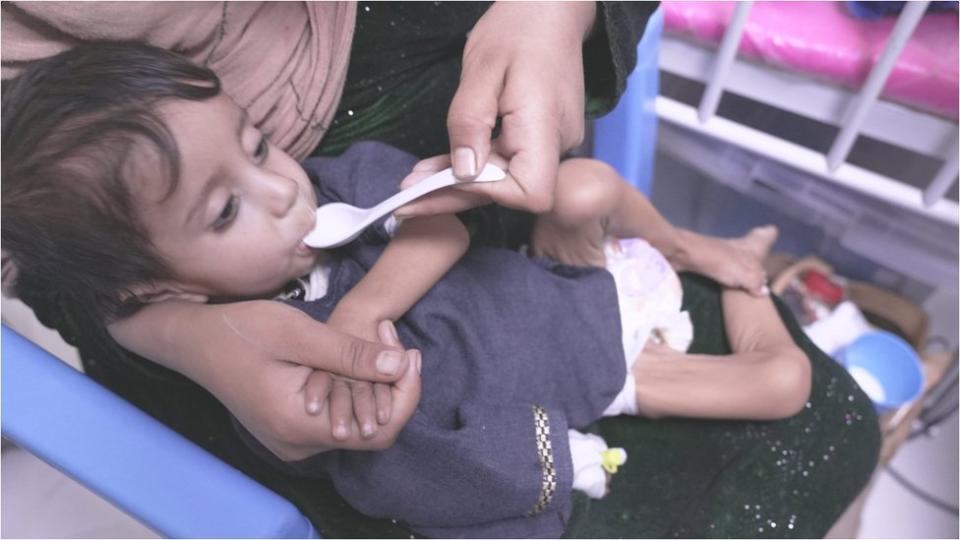 Un niño pequeño y desnutrido recibido alimento en la boca con una cuchara.