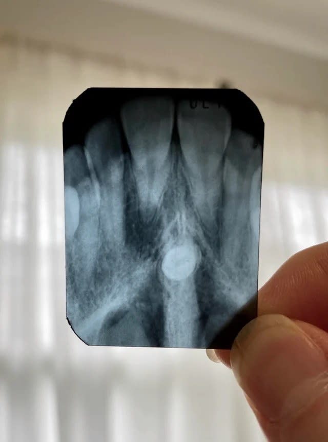 An x ray of a person's mouth showing a tooth in the middle of the roof of their mouth