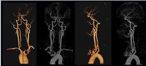 Precise Suite Incisive carotid