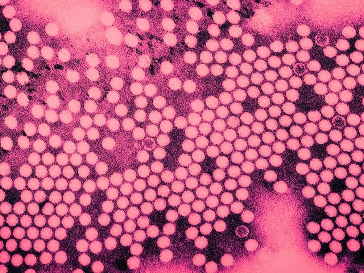 This image shows a colourized electron micrograph of the poliovirus, taken in 1975.  (U.S. Centers for Disease Control and Prevention - image credit)