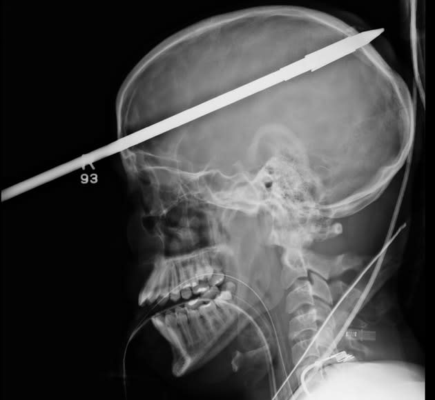 An X-ray showing a spear that has pierced through the head of 16-year-old Yasser Lopez is seen in this handout photo from Jackson Memorial Hospital in Miami, Florida provided to Reuters June 19, 2012. Lopez was spear fishing with a friend when he was accidentally shot in the head. The spear entered just above his right eye, and penetrated through his brain to the back of his skull. Miraculously, no vital brain structures were damaged by the harpoon, and Lopez is now recovering from the incident. REUTERS/Jackson Memorial Hospital/Handout