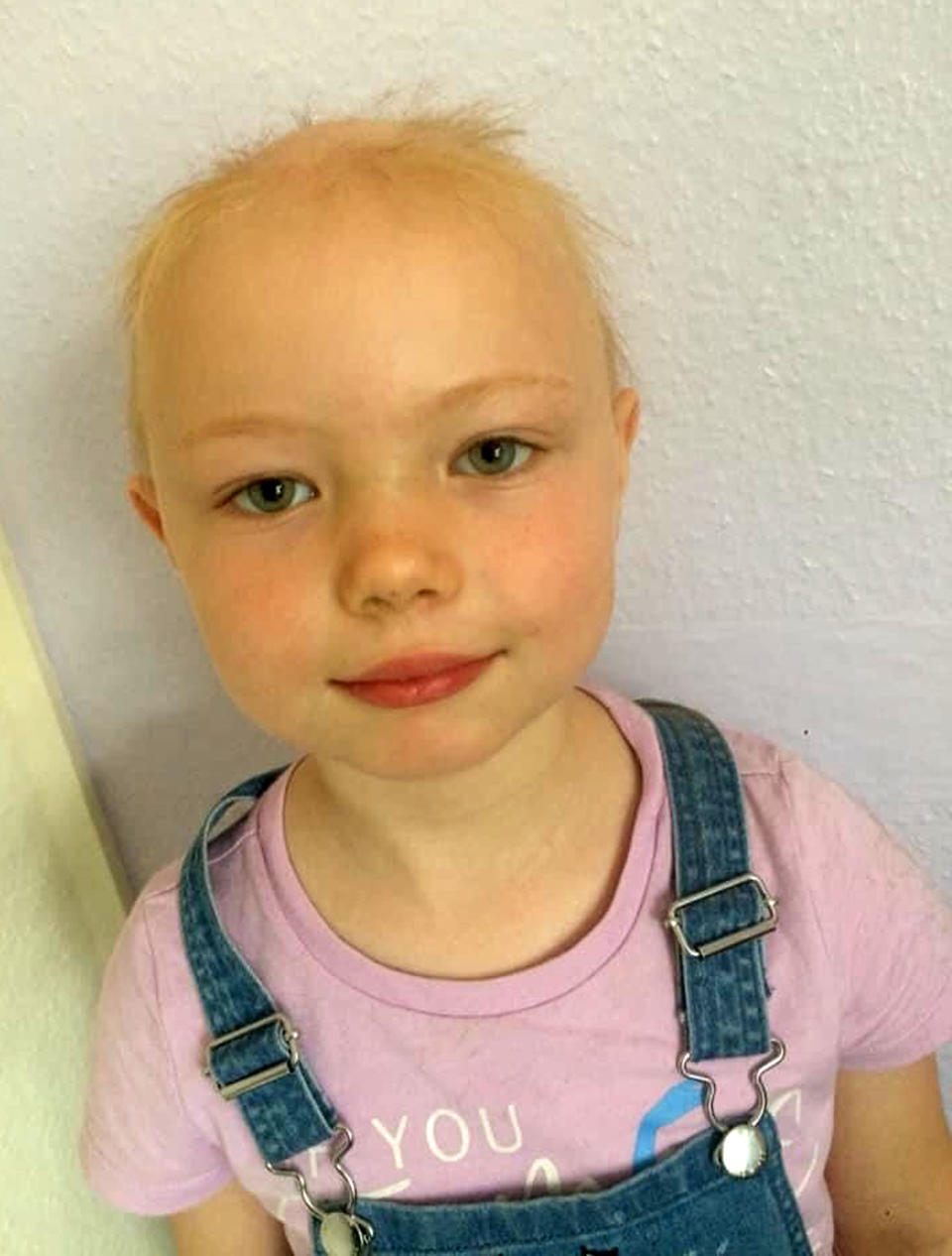 Niamh started to lose her hair when she was just three years old and now, she has no hair, eyebrows, or eyelashes. (Caters)