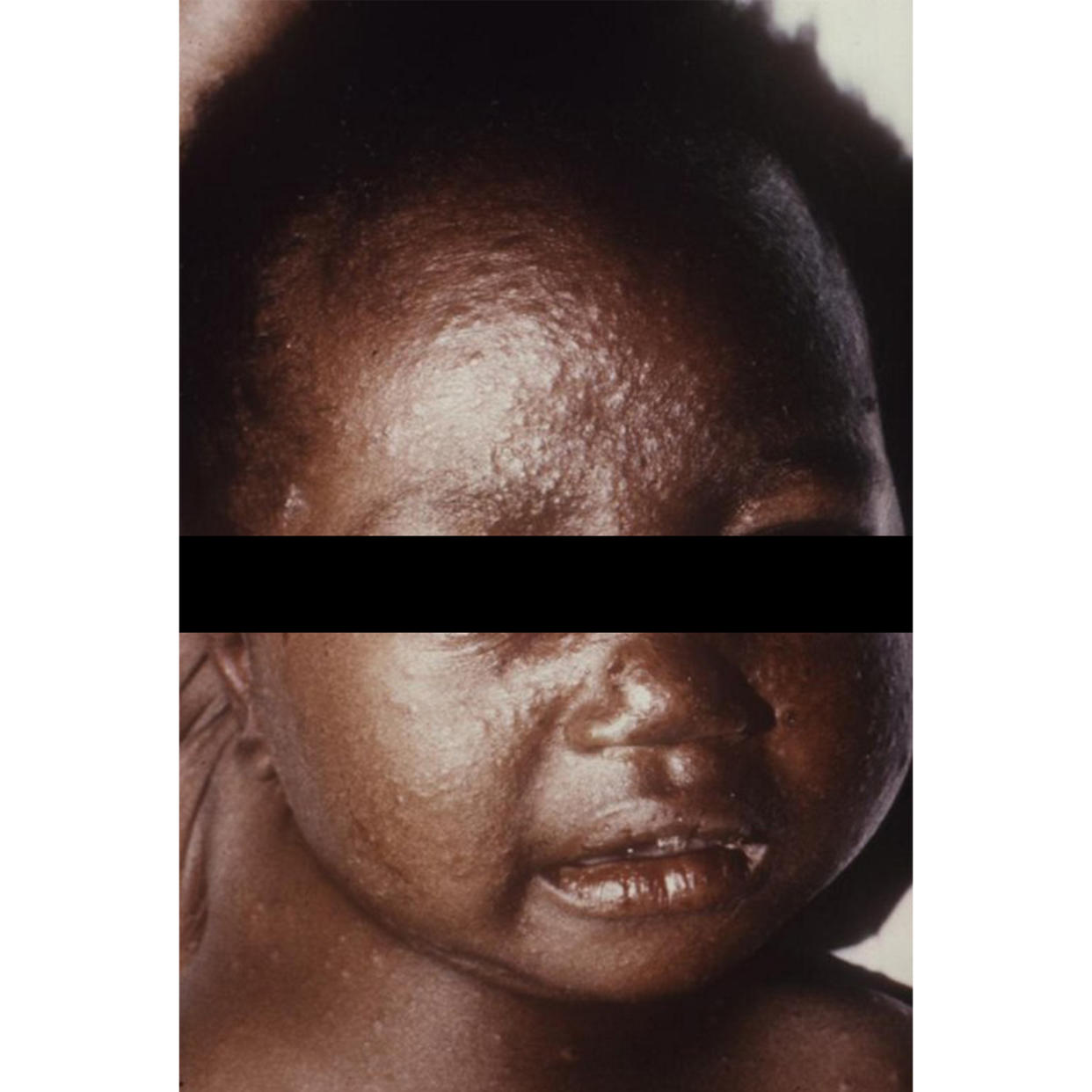 Photos of chicken pox skin condition on a black African American child (CDC)
