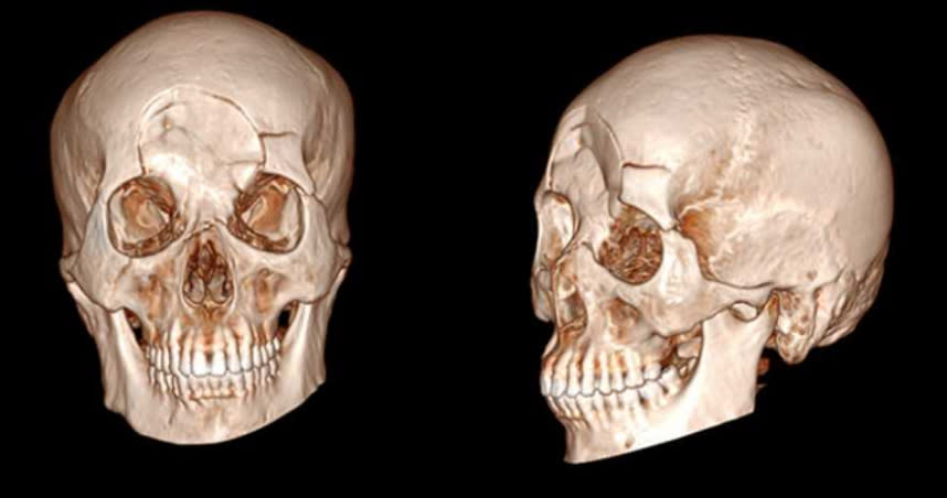 湯男的顱骨嚴重受損。（圖／翻攝自澎湃新聞，下同）