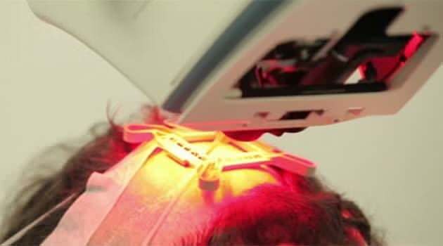 A new robotic technology treating baldness is being hailed by patients. Photo: 7News