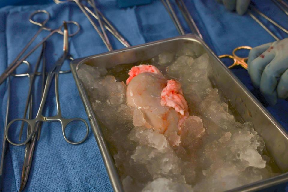 2024年3月16日，美國麻薩諸塞州總醫院（Massachusetts General Hospital）為患者史萊曼進行豬腎移植手術。美聯社