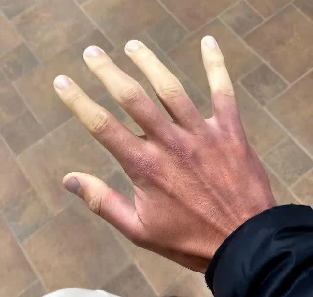 Every end of my fingers are curved up permanently : r/mildlyinteresting