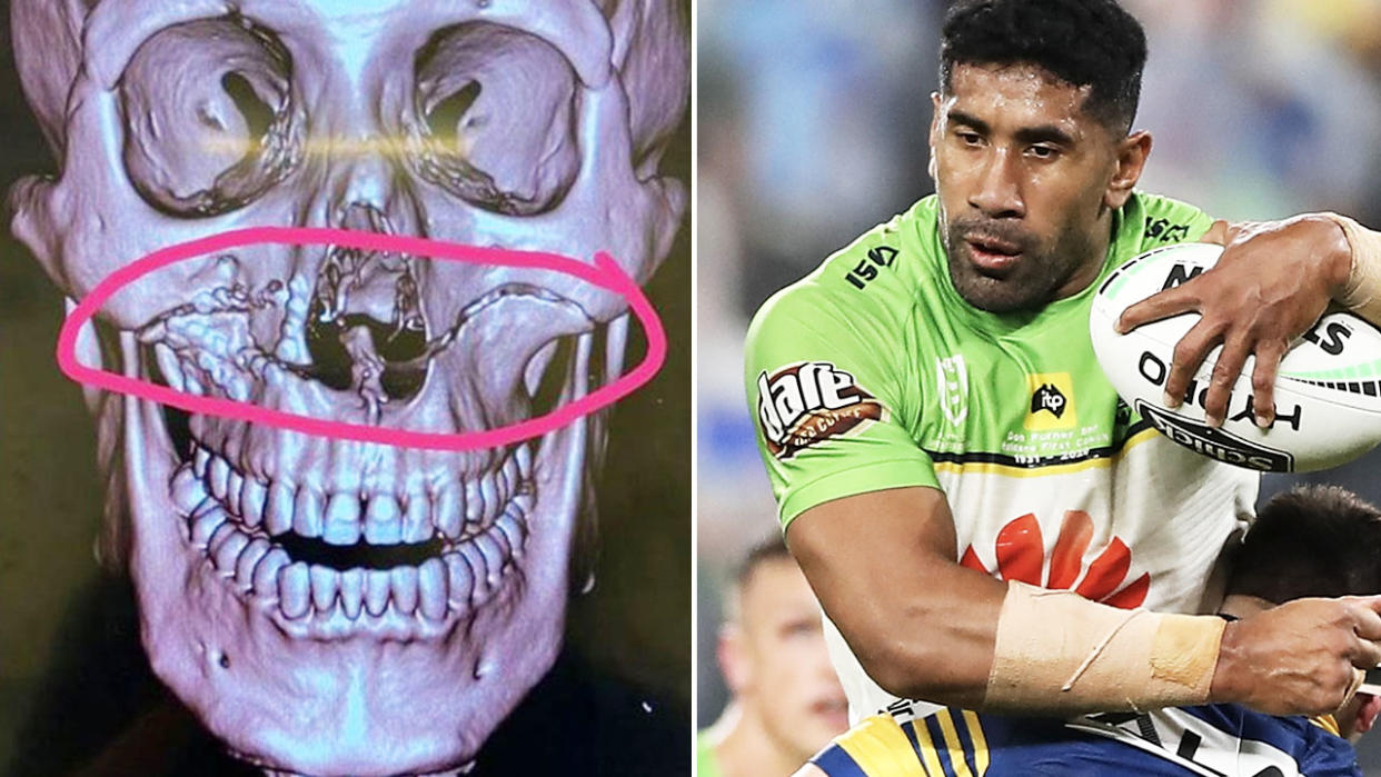 Sia Soliola, pictured here after suffering awful facial fractures.