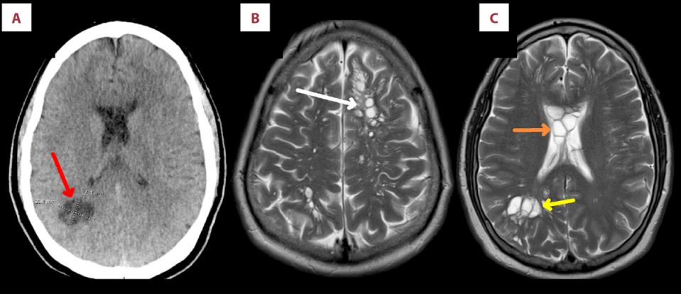 Brain scan showing man had many tapeworm larvae growing in different parts of his brain (Byrnes E, Shaw B, Shaw R, Madruga M, Carlan SJ/Am J Case Rep)