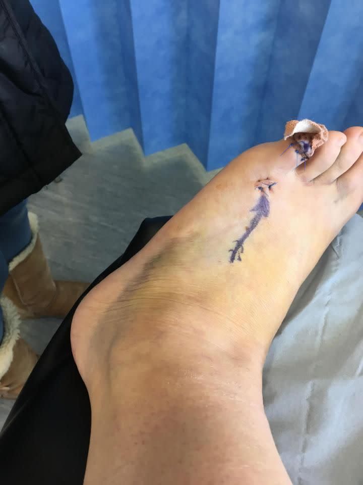 Doctors had to snap all the tendons and break her toe. Photo: Supplied