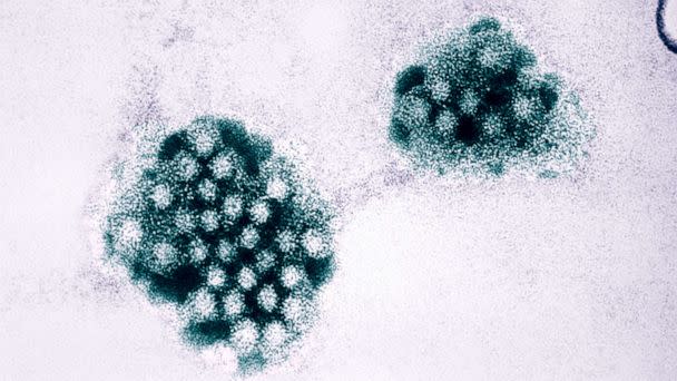 PHOTO: In this undated file photo, an electron micrograph of the norovirus is shown. (UIG via Getty Images, FILE)