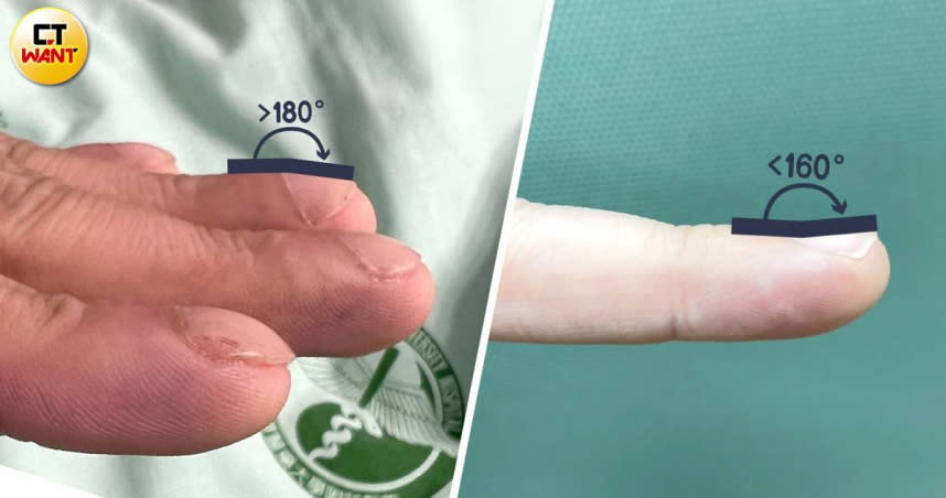 病人阿成因長期缺氧造成杵狀指，呈現手指末端腫脹，指甲從根部到末端呈拱形隆起，讓甲床與指節角度變大，甚至大於180度（圖左）；正常的指甲床與第一指節的角度通常呈150~160度，甲床與指節角度會小於160度（圖右）。（圖／中國醫藥大學附設醫院提供）