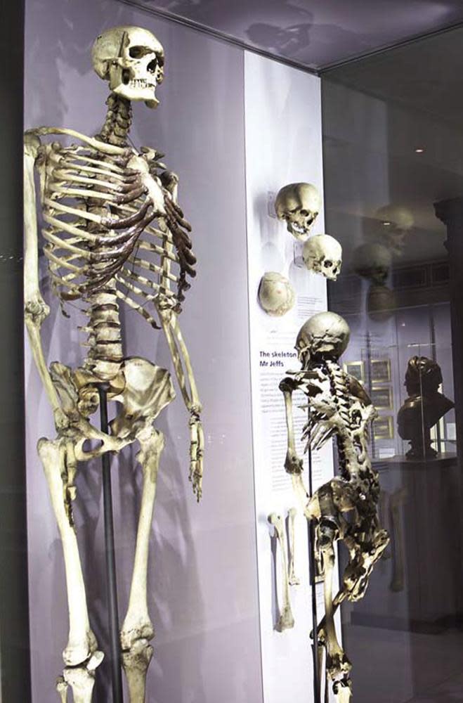 The skeleton of Charles Bryne on display at the Hnterian Museum in 2005.