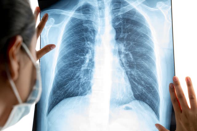 <p>Getty</p> Stock image of a chest x-ray