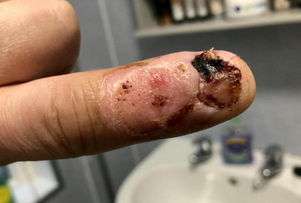 Doctors aren't sure if Steven's nail will grow back [Photo: SWNS]