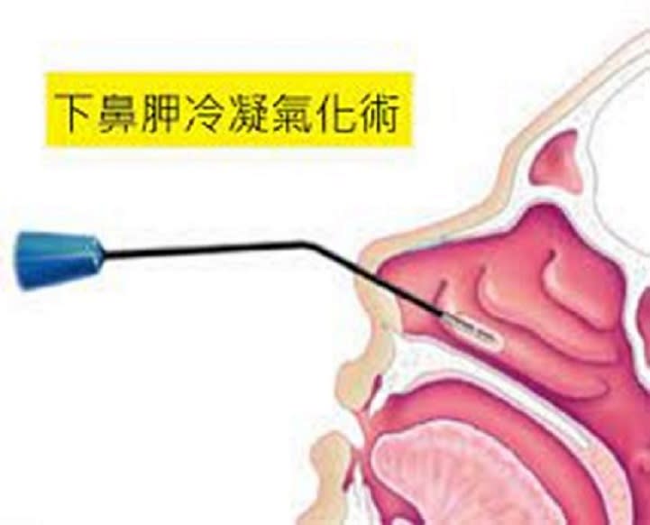 在臉上”動手腳”　下鼻甲冷觸氣化術解決愛睏目及黑眼圈