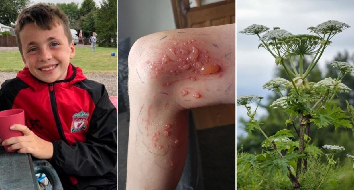 Jayden Bird, nine, was left with third-degree burns after brushing against hogweed while on a camping holiday. (SWNS)