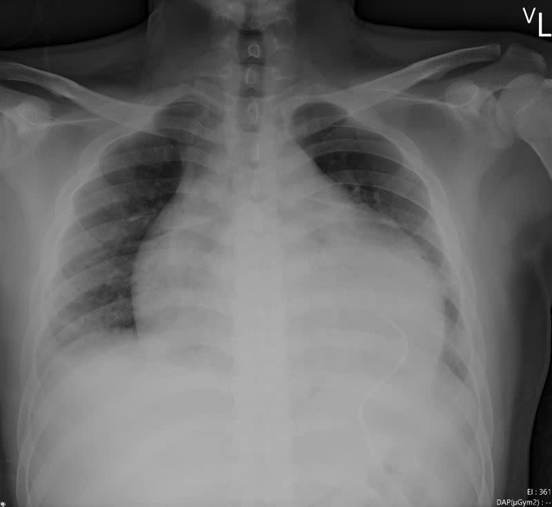 胸部X光可見心臟嚴重擴大，放置引流管減少積水，並以支持式療法治療，數日後才逐漸改善，最後病患順利出院。（圖／翻攝自花蓮慈濟醫院）