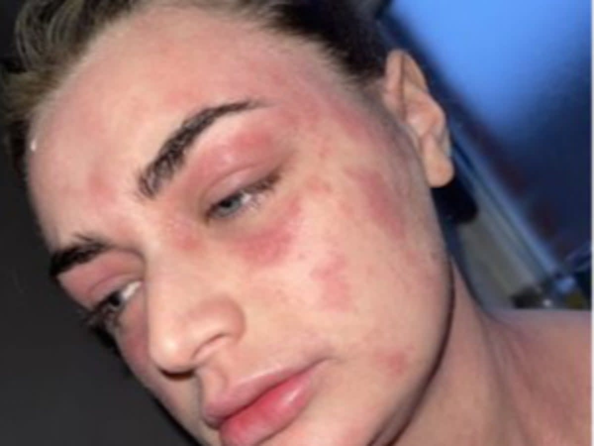 Rhiannon Kennedy-Chapman was left in agony after red rashes broke out all over her body  (Rhiannon Kennedy-Chapman)