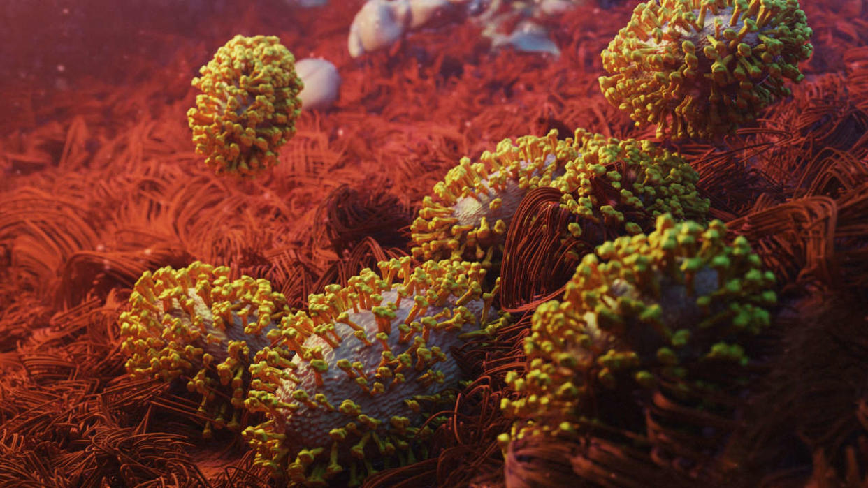 3D art of the monkeypox orthopoxvirus as seen under the microscope and showing the virus structures in great detail simulating a diseased person, it's from the same family as the smallpox and can be transmitted human to human