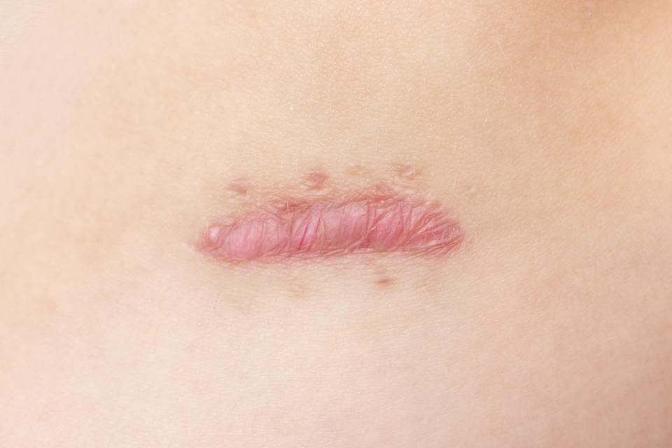 La cicatriz queloídea es una lesión con aspecto tumoral, color rojo rosado o púrpura y a veces hiperpigmentada. Los contornos están bien demarcados, pero son irregulares, sobrepasando los márgenes iniciales de la herida. Puede presentar prurito y dolor. (Foto: Getty)