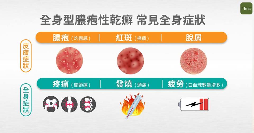 全身型膿疱性乾癬常見全身症狀