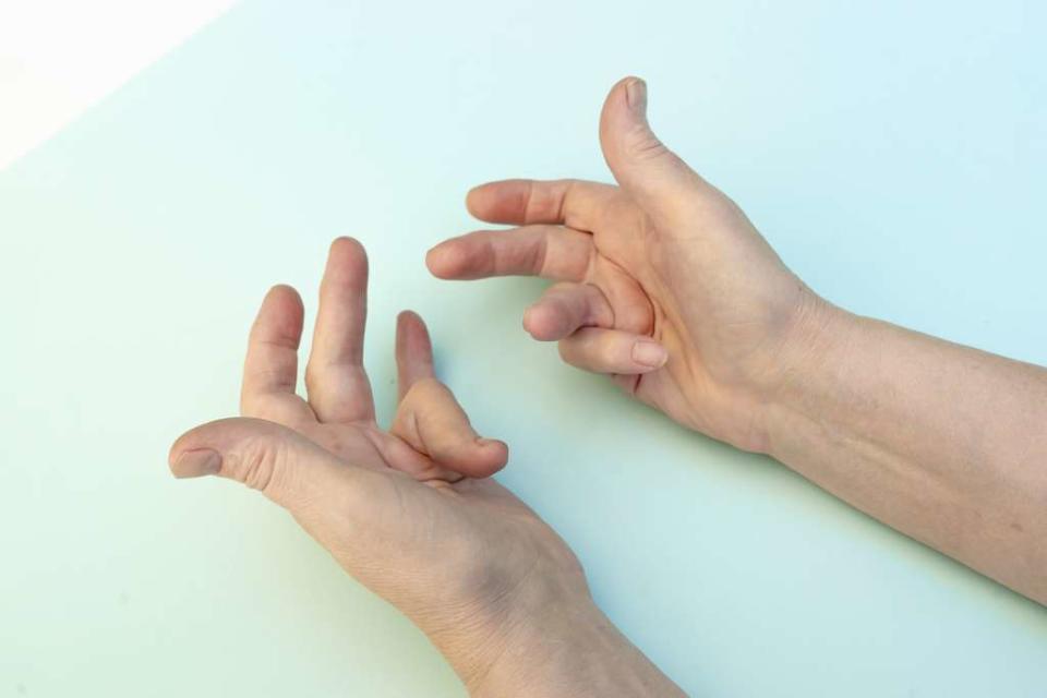 Les mains en griffe caract&#xe9;ristique d&#39;une patiente atteinte de la maladie de Dupuytren. &#xa9; Elena Shi, Adobe Stock