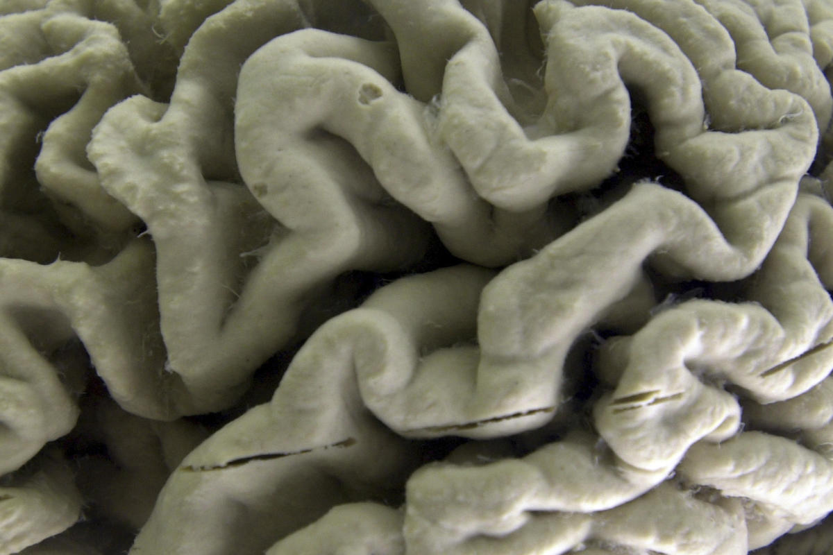 New Study Suggests Alzheimers Disease May Be More Inherited Than Previously Known