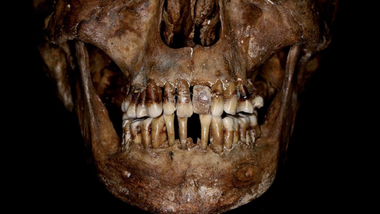  The woman was suffering an inflammation of the gums and bones that had loosened her teeth, so she'd had them fixed in place with fine gold wires. 