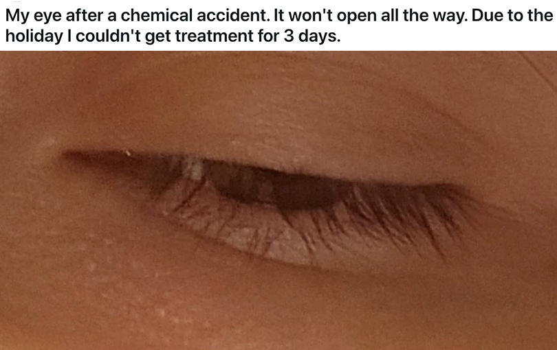 "My eye after a chemical accident"