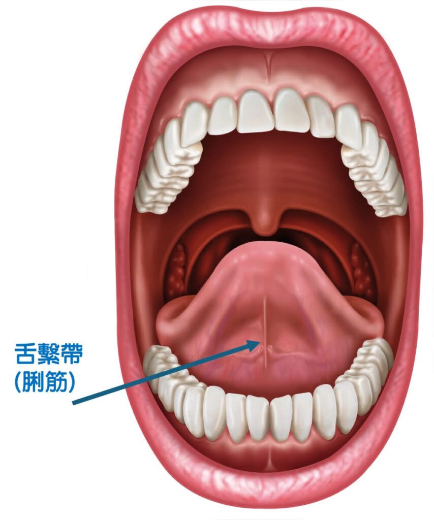 舌繫帶(脷筋)位置，是舌頭下連接着口腔底部的一條小黏膜。舌繫帶過短就會造成黐脷筋。