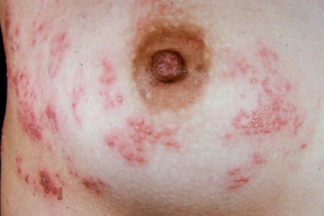 Amazing Remedies for Rash Under Breasts