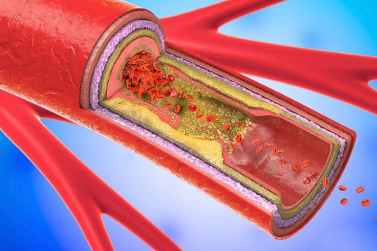 Las arterias se obstruyen de manera asintomática por el colesterol 