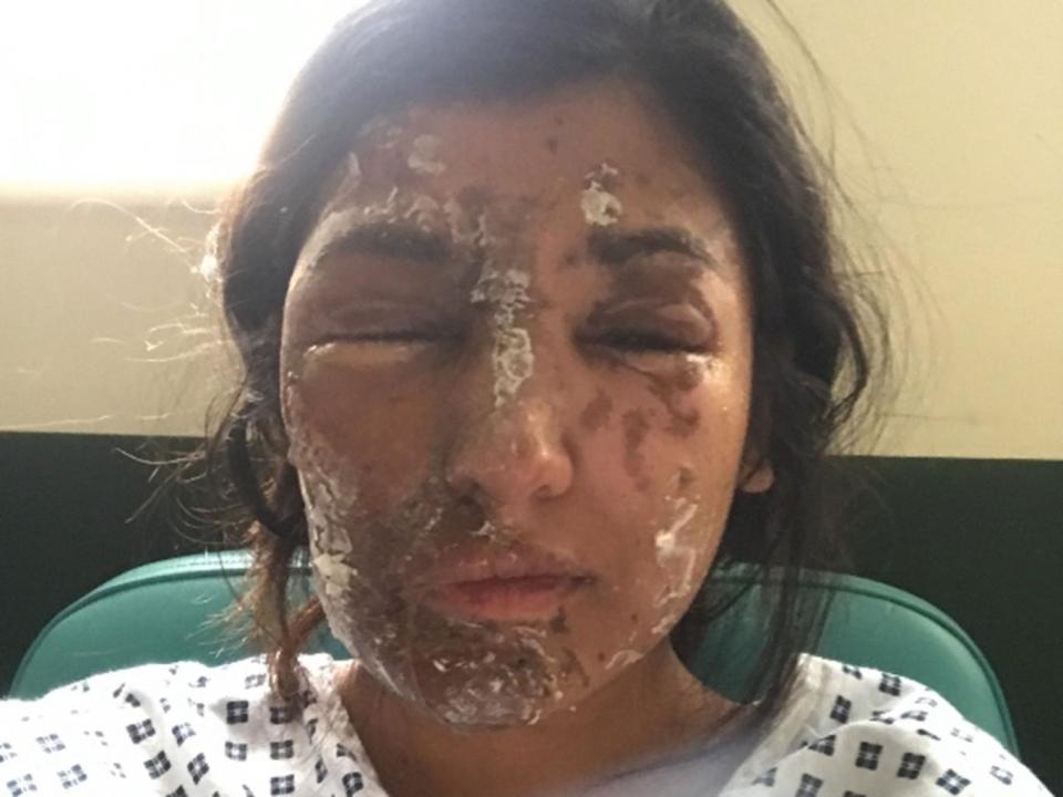 Resham Khan in hospital following an acid attack on 21 June (Gofundme)