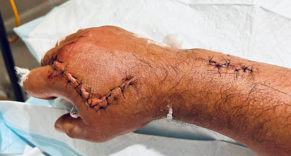 Alexey  Barkhatov 's hand and lower arm with lacerations and thick stitches  due to the accident.