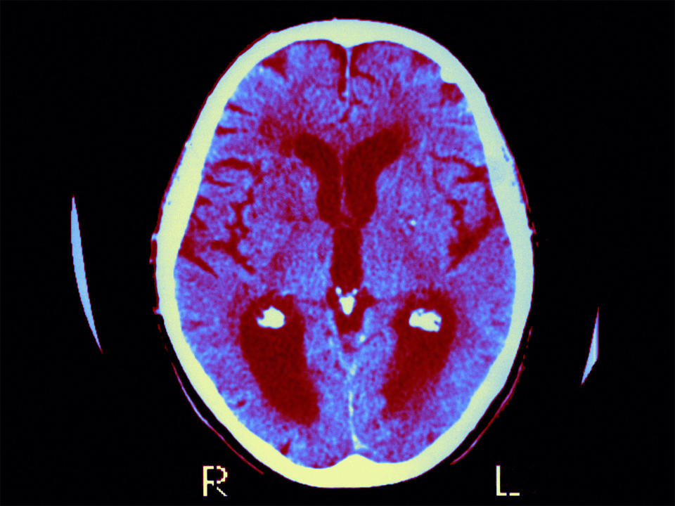 'Holy grail' blood test for early Alzheimer’s indicators could help patients begin treatment before they show symptoms