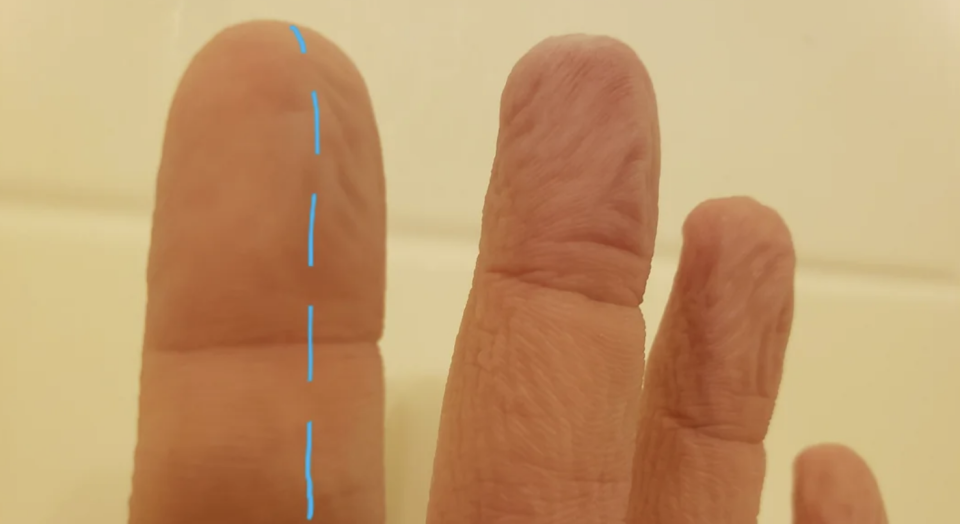 Three wrinkled fingers with the middle finger marked by a blue dashed line